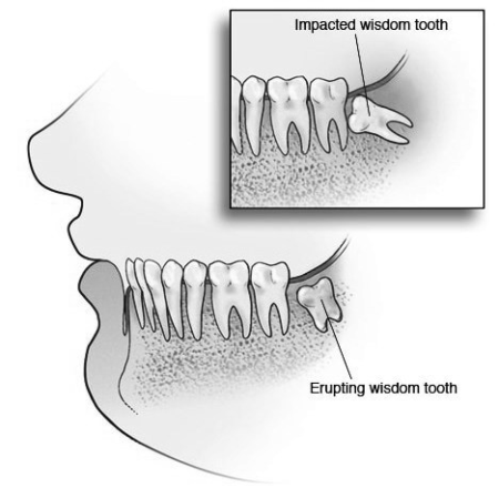 Wisdom Tooth explained – Dr Sanjay Nayak's Dental Speciality Clinic ...